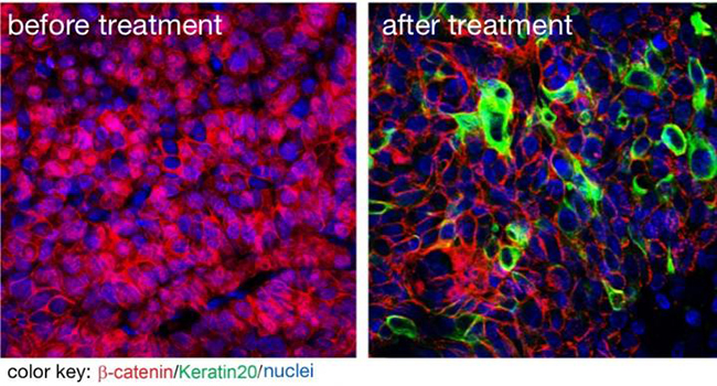 A new inhibitor suppresses tumor growth and cancer stem cells. The image on the left shows beta catenin (red) in cell nuclei indicating that these are cancer stem cells. The image on the right shows that the new substance successfully removed beta catenin from the nuclei. [Picture by Liang Fang for the MDC]