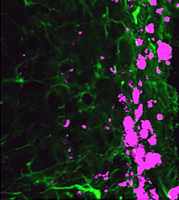 Reprogrammed stem cells (green) chase down and kill glioblastoma cells (pink), potentially offering a new and more effective treatment option for a disease that has not had any in more than 30 years. [UNC Eshelman School of Pharmacy]