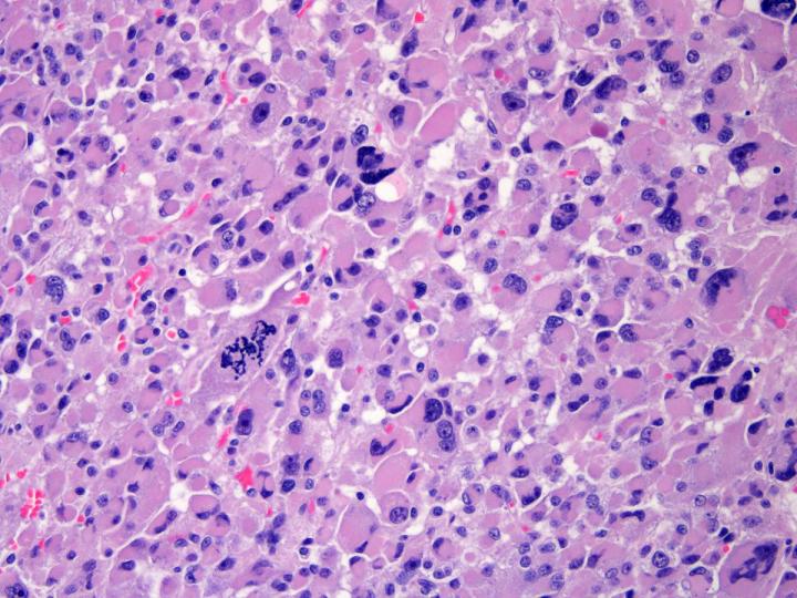 A new study finds a third class of adrenocortical carcinoma (shown above), and identifies new genes associated with this rare cancer of the adrenal glands. [University of Michigan Comprehensive Cancer Center]