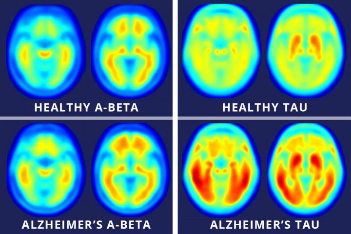 Images across the top show compilations of PET brain scans of people who are cognitively normal. Images across the bottom show compilations of PET brain scans of patients with symptoms of mild Alzheimer's disease. The difference between scans of healthy people and scans of patients with mild Alzheimer's disease is much more apparent in the images that measure tau (right four images), suggesting tau protein buildup in the brain is a better marker of Alzheimer's disease symptoms than the long-studied amyloid beta buildup (left four images). [Matthew R. Brier]