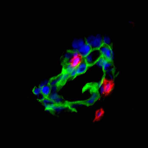 T cells (red) attack ovarian cancer cells (green). [University of Michigan Health System]