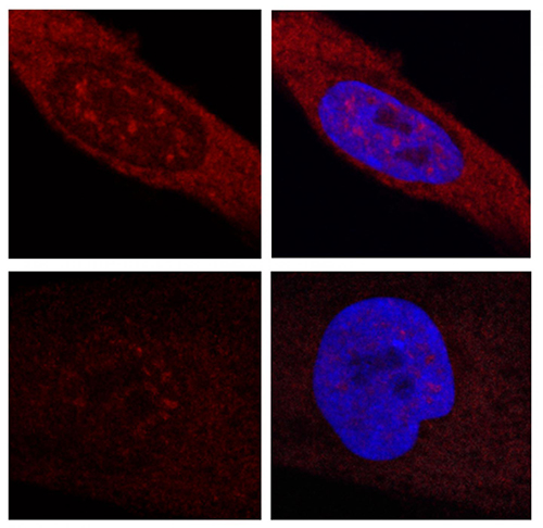 Image of fibroblasts from patients with Huntington's disease marked with fluorescence. Above, the cells show mutated RNA accumulation. Below, the cells no longer express RNA-blocked accumulations. [CRG]