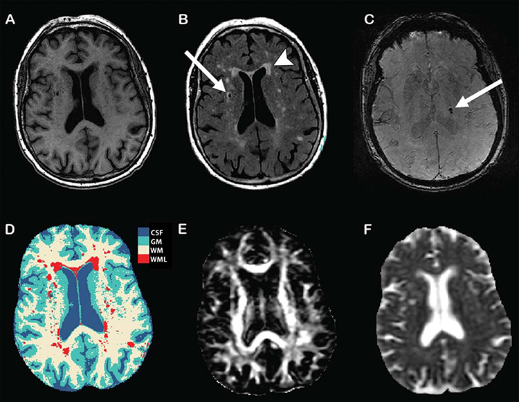 Structural and microstructural MRI markers of subclinical brain damage. The left side of each image corresponds to right side of the brain. (A) T1-weighted image. (B) Fluid-attenuated inversion recovery image shows white matter lesions (arrowhead) and lacunar infarct (arrow). (C) Three-dimensional T2* gradient-echo MRI shows cerebral microbleeds (arrow). (D) Tissue segmentation, with each tissue type represented by a different color. CSF, cerebrospinal fluid; GM, gray matter; WM, white matter; WML, white matter lesion. (E) Diffusion-tensor imaging map of fractional anisotropy. (F) Diffusion-tensor imaging map of mean diffusivity. [Radiological Society of North America]