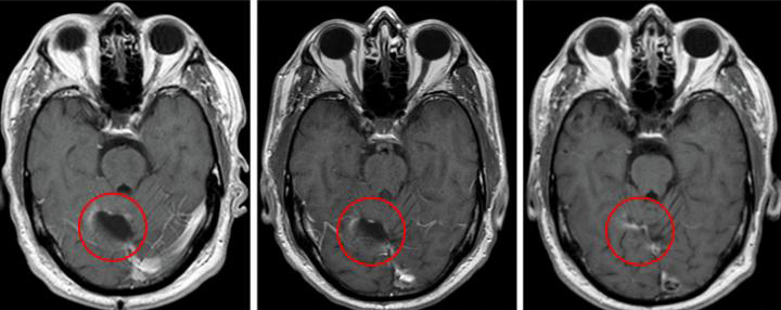 Brain scan from a trial patient showing significant shrinkage of the tumor. [Clinical Cancer Research/American Association for Cancer Research]