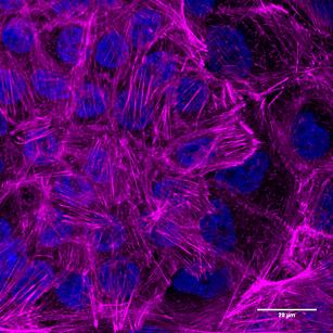 This is an accumulation of cytoskeleton fibers (magenta) in benign breast tumor cells. The cell nucleus is seen in blue. [Sandra Tavares/IGC.]