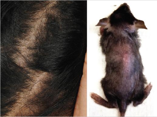 Hair thinning in a human patient and mouse with inherited loss-of-function mutations in WNT10A is shown. [Michael Passanante and Mingang Xu/UPenn]