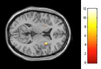 fMRI tests revealed increased activity in the right insula, the part of the brain that regulates satiety and cravings, after participants consumed walnuts. [Beth Israel Deaconess Medical Center]