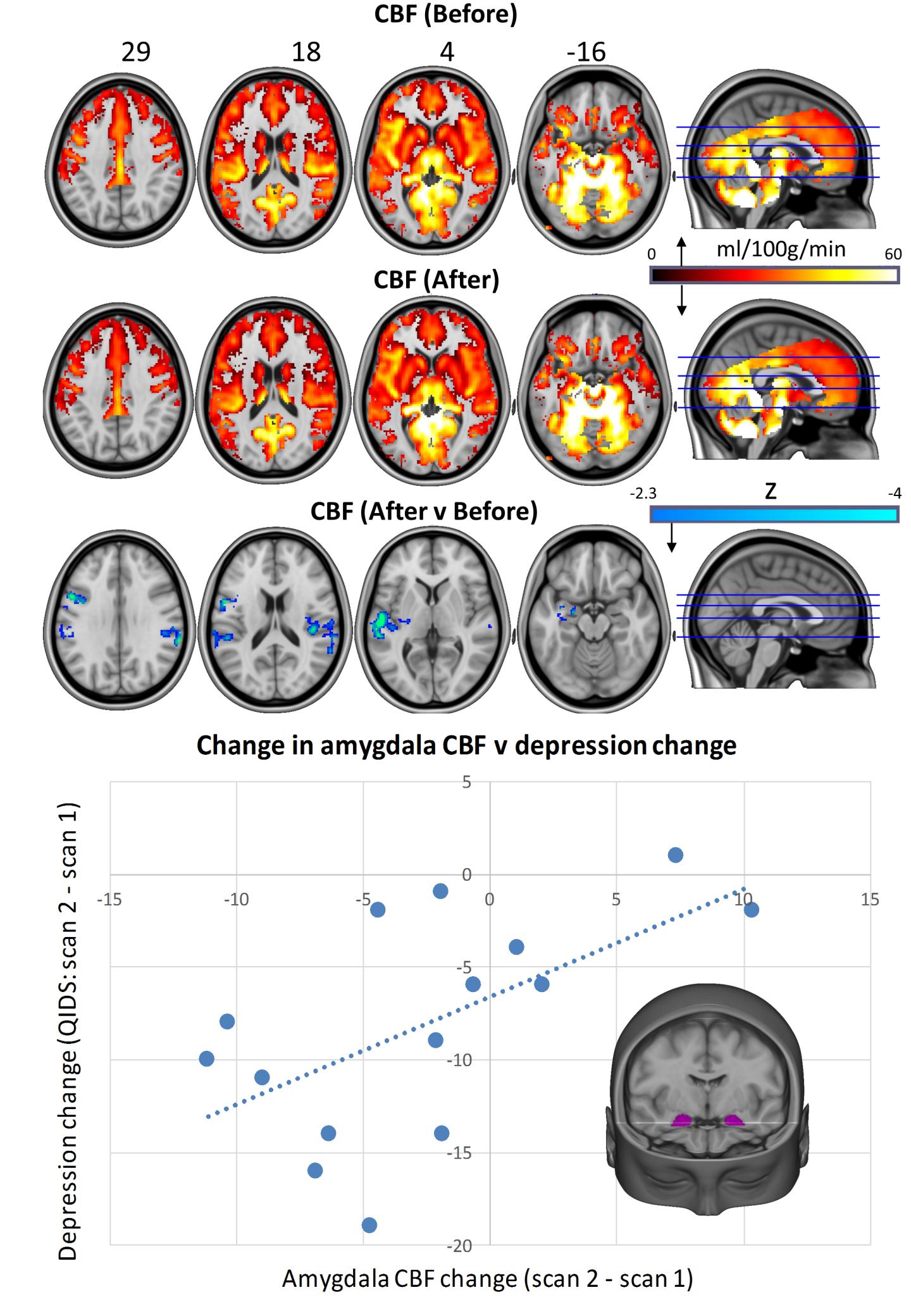 Whole-brain cerebral blood flow maps for baseline versus one-day post-treatment, plus the difference map (cluster-corrected, p < 0.05, n = 16). Correlation chart shows post-treatment changes in bilateral amygdala cerebral blood flow versus changes in depressive symptoms (r = 0.59, p = 0.01). One patient failed to complete the scan 2 QIDS-SR16 rating, reducing the sample size to n = 15 for the correlation analysis. In all of the images, the left of the brain is shown on the left. Carhart Harris et al., Scientific Reports 2017