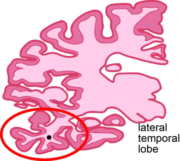 Coronal section of human brain indicating the lateral temporal lobe (red circle) used in this study. [The lab of Shelley Berger, Ph.D./Perelman School of Medicine, University of Pennsylvania]