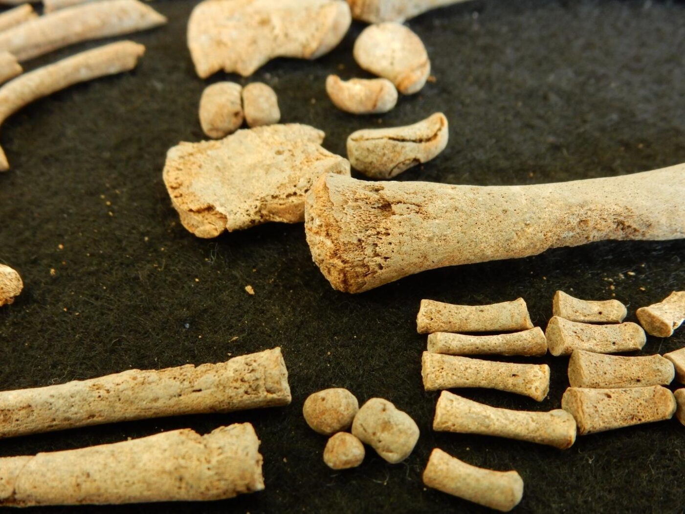 These are skeletal remains from individual 94A, who was infected with syphilis and was 6 months old at the time of death. The skeleton displays characteristic signs of a treponemal disease. [Rodrigo Barquera. Santa Isabel collection, Lab. of Osteology, ENAH, Mexico (permission No. 401.15.3-2017/1065 INAH).]