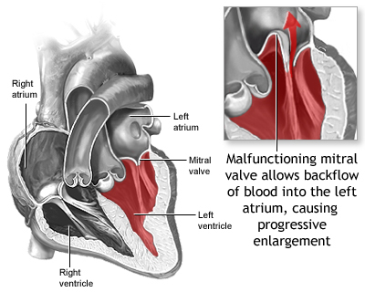 Mitral valve prolapse is a disorder in which, during the contraction phase of the heart, the mitral valve does not close properly. When the valve does not close properly it allows blood to backflow into the left atrium. [Courtesy of U.S. National Library of Medicine]
