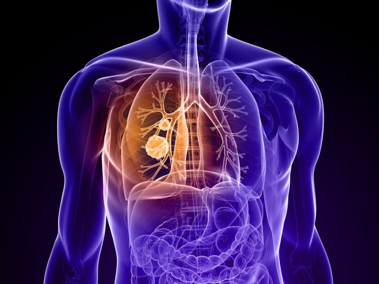 Novel Lung Cancer Biomarkers Identified