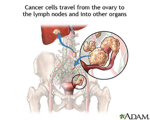 Gynecologic cancer typically originates from the female reproductive organs, and include endometrial and ovarian cancer, among others. Survival rates are typically very poor for these cancer-types, with limited response to existing therapies. [NIH]