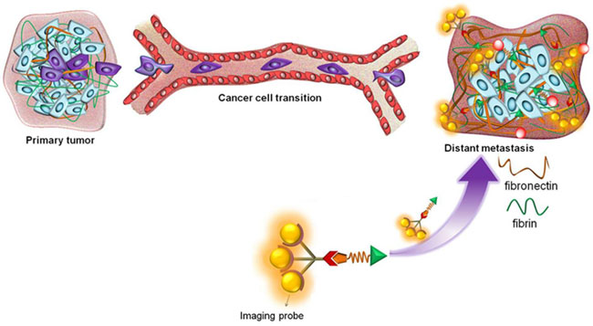 Metastasis occurs when cells are shed from primary breast cancer tumor and establish a new tumor at a distant site. CWRU researchers developed a probe that binds to fibrin-fibronectin protein complexes in high-risk tumors. Fibronectin is expressed in high-risk (aggressive) cancer and not in normal tissue, so MRI imaging is able to distinguish metastases from normal tissue. [Lu Lab, CWRU]