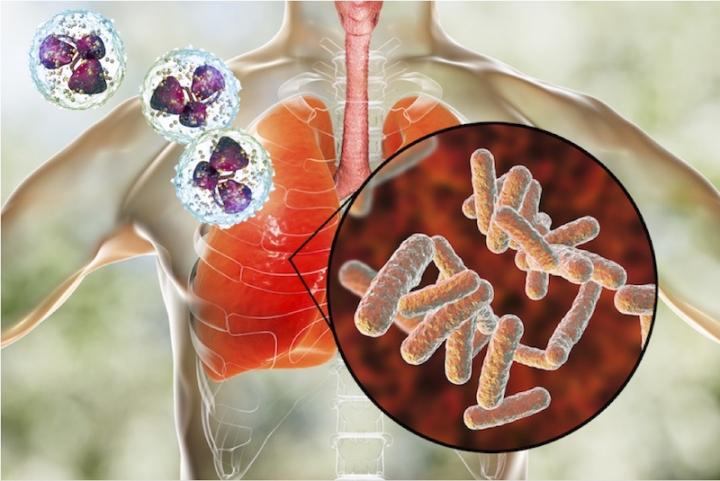 bacterial pneumonia cell