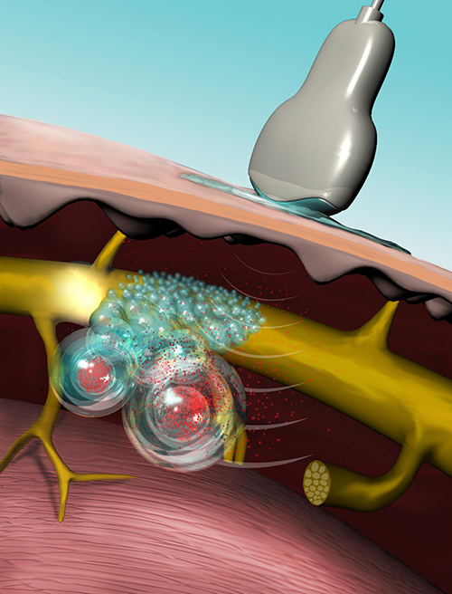 Illustration showing ultrasound triggering liposomes to release local anesthesia. [Mary O'Reilly]