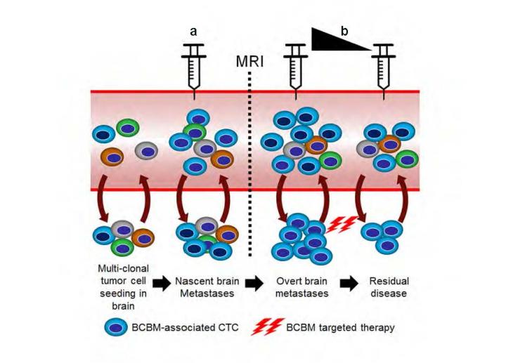 Model illustrates clinical implications of BCBM CTC screening method for brain micrometastases before they become detectable by MRI. BCBM-associated CTCs can be used as a tool to evaluate responses to therapy for BCBM patients. [Houston Methodist]