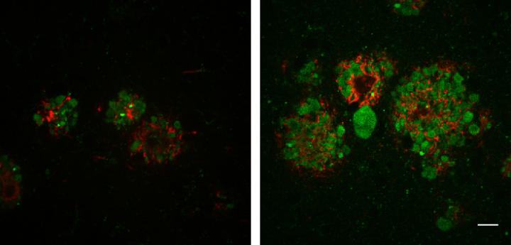 In the brains of mice with Alzheimer's disease, decreased levels of JIP3 (right) induce the formation of larger amyloid plaques (red) and increased numbers of swollen axons filled with lysosomes (green). [Gowrishankar et al., 2017/Journal of Cell Biology]