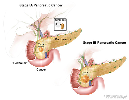 Results from a new study provide evidence that magnesium intake could prevent the development of pancreatic cancer, similar to the early stages shown above. [NIH]