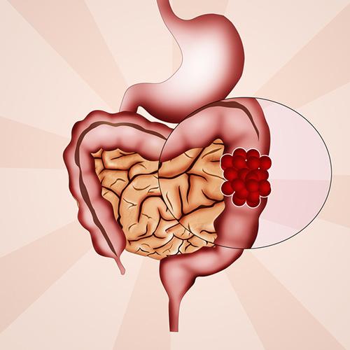 Colorectal cancer currently affects around 1.2 million people in the U.S. and 150,000 new cases are diagnosed every year, making it the third most common cancer in both men and women. Source: © adrenalinapura / Fotolia