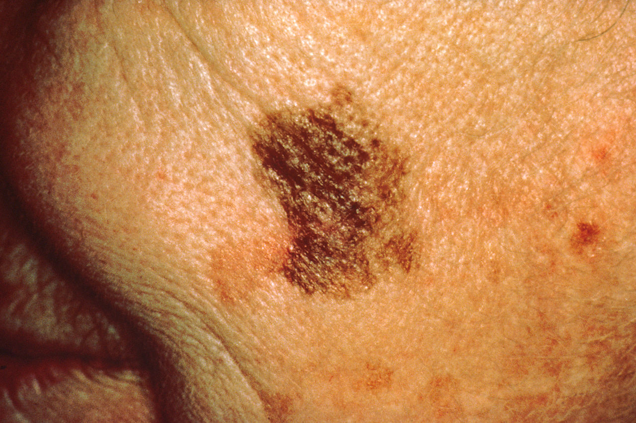 Source: Skin Cancer Foundation/Wikipedia