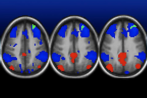 Functional MRI scans show areas in the brains of poor children with normal connectivity highlighted in red and blue and weakened connectivity shown in green. The areas in green are among several areas—detailed in other brain scans—where connections are weakened in children raised in poverty. [Deanna Barch]