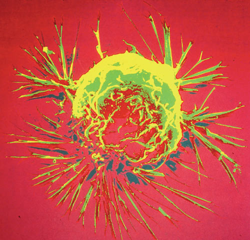Scanning electron microscope image of breast cancer cell. New evidence suggests a weak immune response is associated with recurrence of these tumors. [National Cancer Institute, NIH]