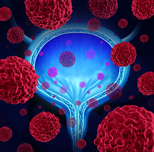 New research offers a possible explanation for why a new type of cancer treatment hasn't been working as expected against bladder cancer. [wildpixel/getty Images]