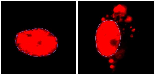 Normally, U2-snRNP (red) is found in the nucleus of motor neurons (left), but it accumulates outside the nucleus in the neurons of patients with ALS and frontotemporal dementia who have a certain genetic mutation. [Reed Lab/Harvard Medical School]