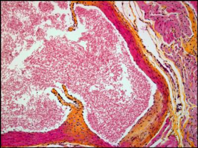 A vaccine-like approach to prevent atherosclerotic heart disease looks promising after a recent paper shows that it has a cholesterol- and inflammation-lowering effect in a mouse model. This image shows a cross-section of a mouse aortic blood vessel in a mouse immunized with AT04A, a peptide-based formulation that raises antibodies against PCSK9, an endogenous protein that interferes with cholesterol clearance. Notice that the vessel appears to have little or no plaque. [The Netherlands Organization of Applied Scientific Research]