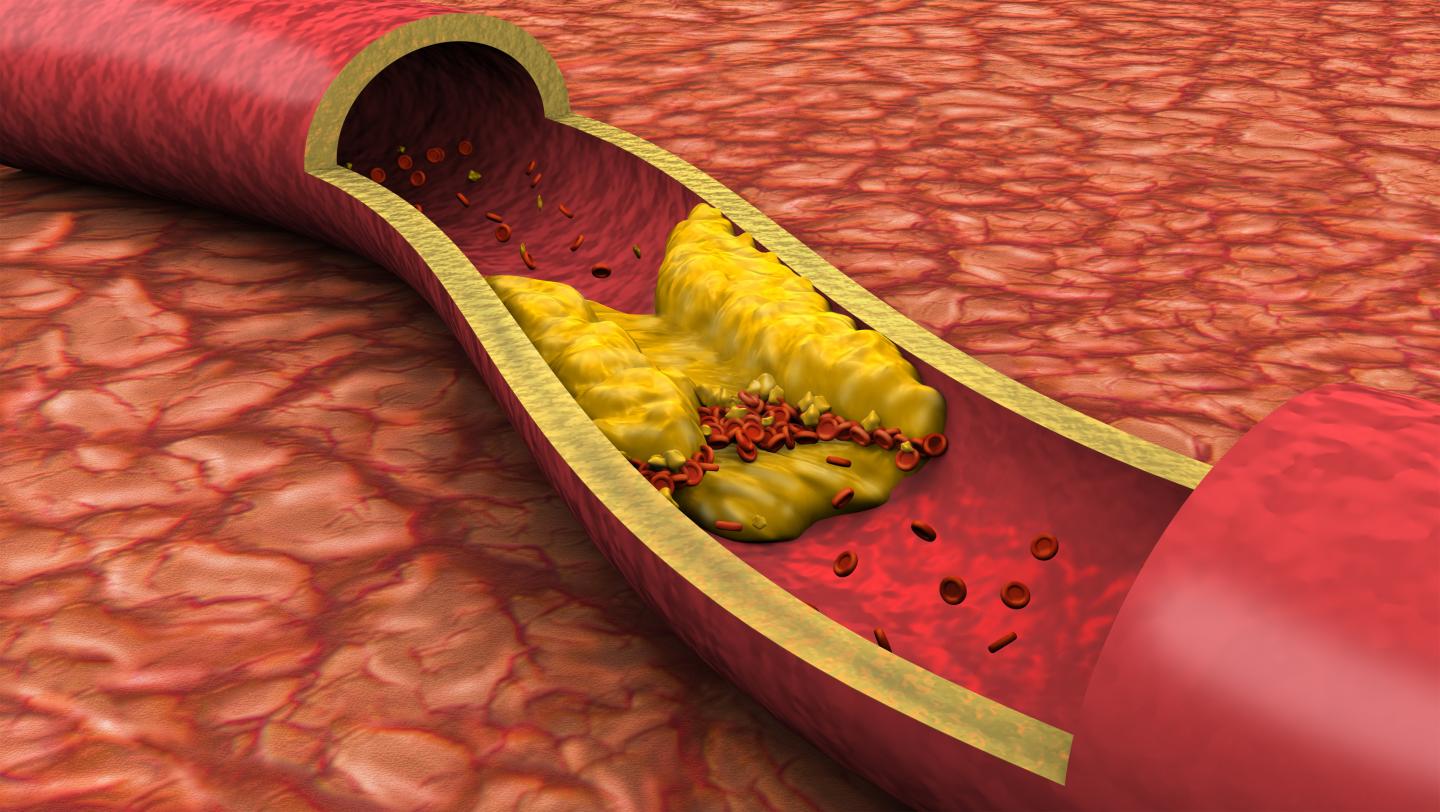 Researchers are revisiting their views on the relative dangers soft and hard atherosclerotic plaque deposits pose to heart health. Findings of a new study by researchers at the Intermountain Medical Center Heart Institute may be a 