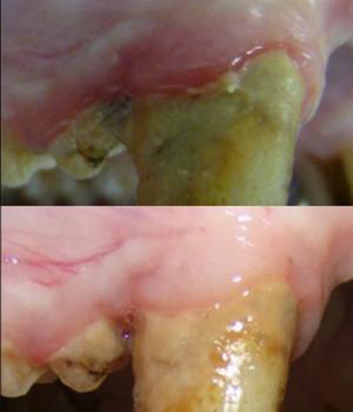 A tooth before (top) and after (below) 6 weeks of treatment shows noticeable improvements in redness and inflammation. [University of Pennsylvania]