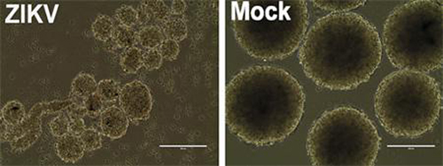 This image shows human neurospheres infected with the Brazilian Zika virus after 96 hours. Compared to mock-infected controls, the neurospheres show dramatic cell death with arrested growth, resulting is significantly reduced size. [UC San Diego Health]