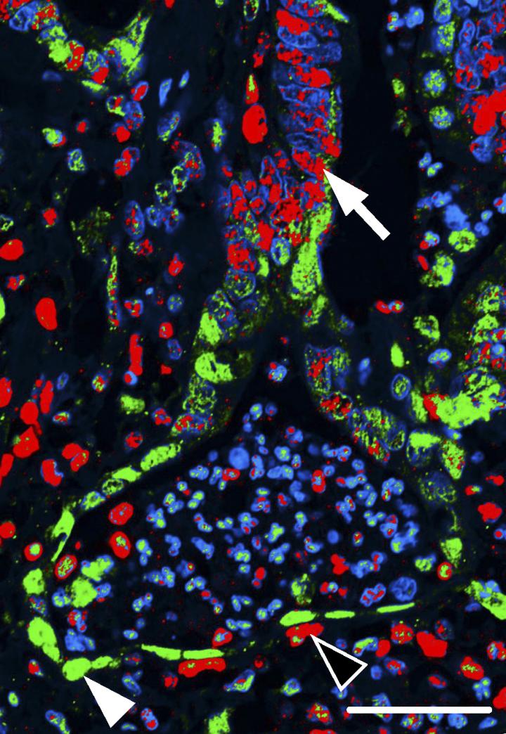 Human colon cancers contain two populations of cancer cells, one at the tumor edge in which the MAPK pathway is highly active (indicated by green staining and the white arrowhead), and one in the center of tumor in which the NOTCH pathway is activated (indicated by red staining and the white arrow). [Schmidt et al., 2018]