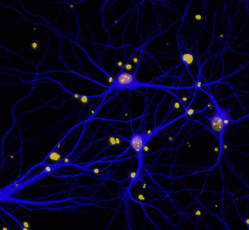 This image shows reduced levels of BRCA1 (red) in neurons (blue). Amyloid-beta plaques in the brain can deplete neurons of BRCA1, potentially contributing to cognitive deficits in Alzheimer's disease. [Elsa Suberbielle/Gladstone Institutes]