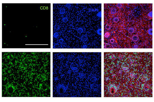 Immunosuppressive tumors in mice have been eradicated by an immunotherapy that incorporates four parts: an antibody targeted to the tumor; a vaccine targeted to the tumor; IL-2; and a molecule that blocks PD1, a receptor found on T cells. In this image, the top row shows few T cells in untreated mice, while the bottom rows show many T cells produced after immunotherapy treatment. [K. Dane Wittrup and Darrell J. Irvine/MIT]
