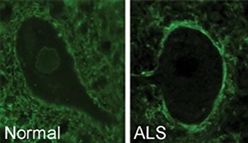 Antibodies surround a healthy motor neuron cell (left) and move to the outer cell membrane in ALS (right). [University of Toronto]