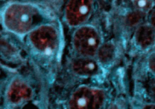 In this image of breast tumor cells, amyloid plaques appear as blue dots. Preventing the disaggregation of such plaques, which form as part of a reversible stress response, could keep tumor cells dormant. [Sylvester Comprehensive Cancer Center]
