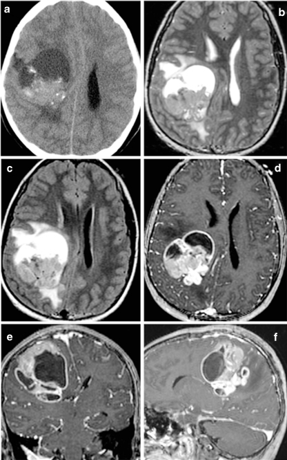 Supratentorial ependymoma in a 10-year-old girl on a noncontrast CT. [E.L. Yuh , A.J. Barkovich, N. Gupta, Childs Nerv Syst (2009)]