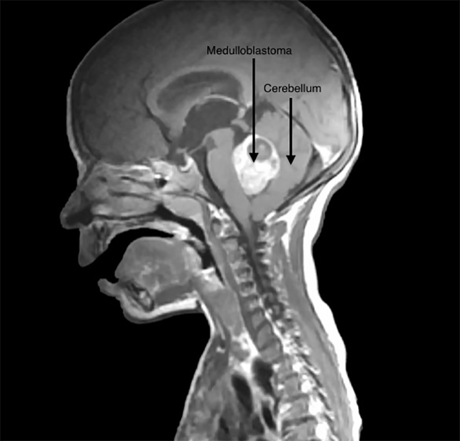 MRI image of medulloblastoma in a young patient. The findings from this new study could help explain why so many of these tumors are able to avoid the immune system. [WikiCommons]