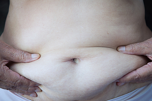 New study finds that body fat distribution in the trunk is more important than body weight when it comes to cancer risk in postmenopausal women. [Sasiistock/Getty Images]