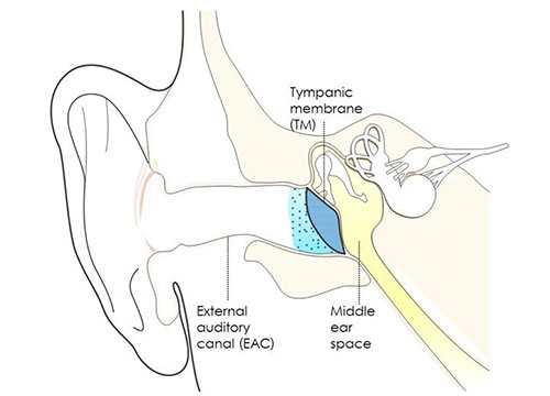 A single-application bioengineered gel, squirted in the ear canal, could deliver a full course of antibiotic therapy for middle ear infections. [Kohane group]