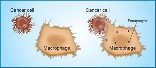 A mouse study found that ferumoxytol prompts immune cells called tumor-associated macrophages to destroy tumor cells. [Amy Thomas]