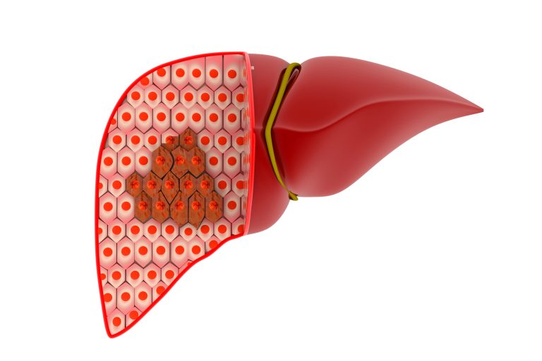 Early Liver Cancer Detection through Glycolytic Genes