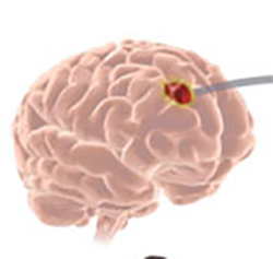 Glioblastoma is the most common primary brain tumor in adults.