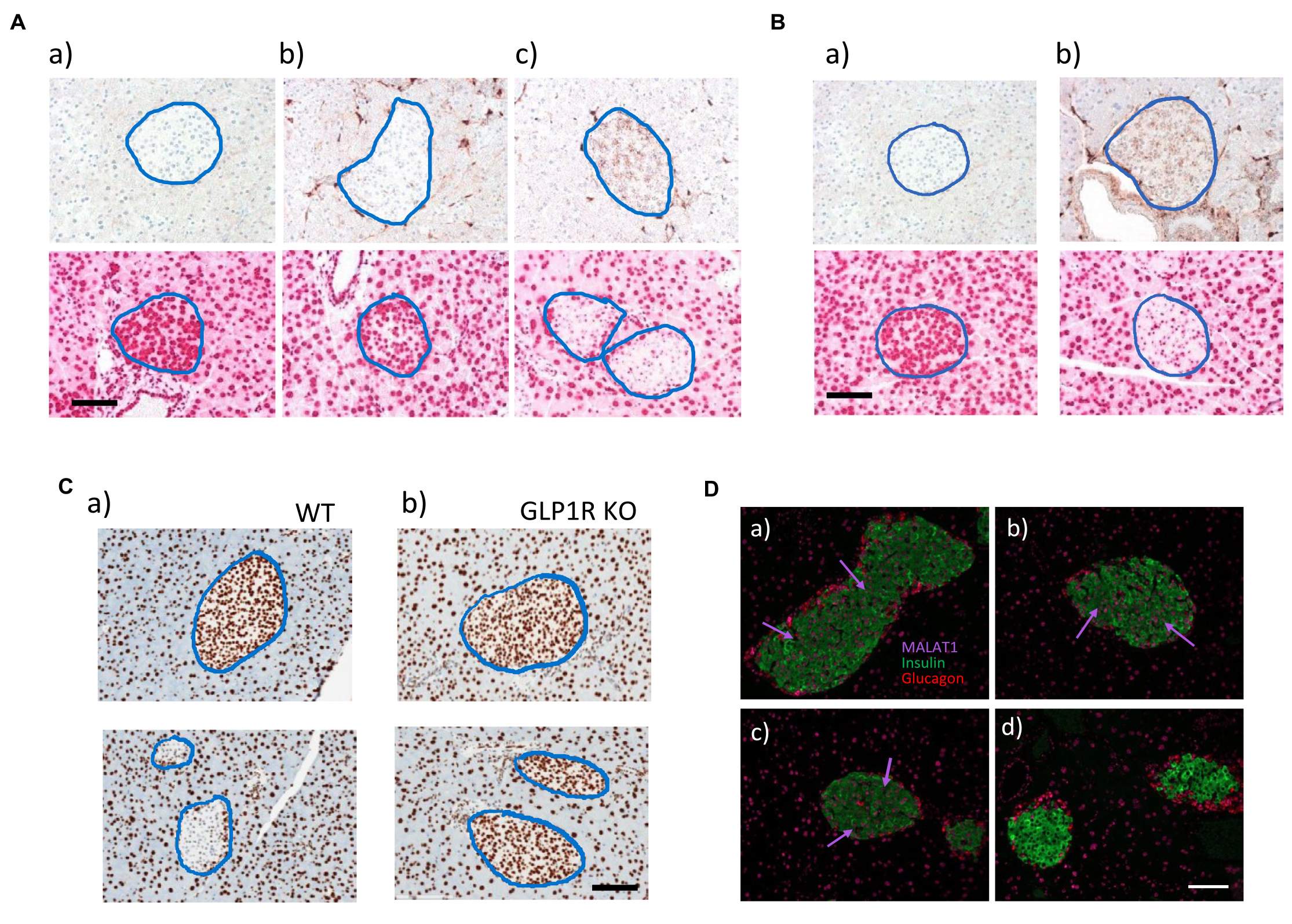 GLP1R-dependent uptake of ASO and knockdown of gene expression in mice treated with eGLP1-ASO conjugates in vivo. (A) Representative pancreatic sections stained for ASO by IHC and MALAT1 RNA by ISH from mice treated for 2 weeks with three subcutaneous injections of (a) saline, (b) MALAT1-ASO (1 µmol/kg), or (c) eGLP1-MALAT1-ASO (1 µmol/kg). (B) ASO uptake by IHC and MALAT1 RNA levels by ISH in pancreatic sections from mice treated for 2 weeks with three intravenous injections of (a) saline or (b) eGLP1-MALAT1-ASO (1 µmol/kg). (C) MALAT1 gene expression by ISH in (a) wild-type (WT) and (b) GLP1R knockout (KO) mice 72 hours after a single subcutaneous dose of saline or eGLP1-MALAT1-ASO (1 µmol/kg). (D) Pancreatic section from wild-type mice stained using fluorescence in situ probes for MALAT1 (purple, arrows), insulin (green), and glucagon (red). Pancreatic sections were collected 72 hours after one subcutaneous administration of (a) saline or (b) MALAT1-ASO and (c) eGLP1-control-ASO or (d) eGLP1-MALAT1-ASO, and all compounds were dosed at 1 µmol/kg. Scale bars, 200 µm. Islets are circled in blue in (A) to (C).   Credit: Ämmälä et al., Sci. Adv. 2018; 4 : eaat3386