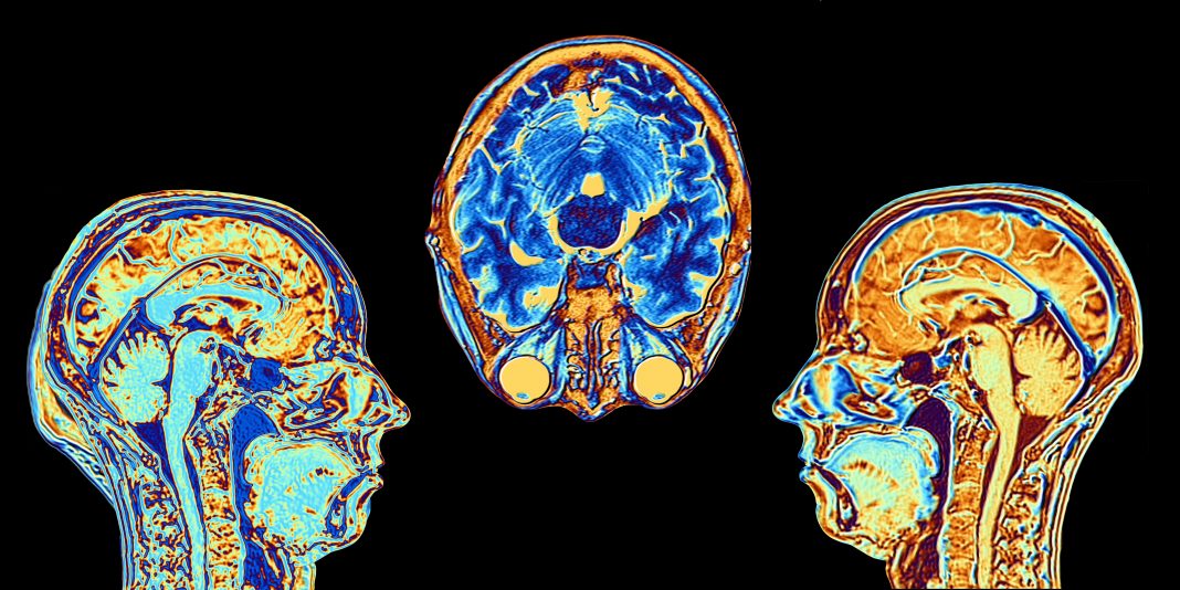 MRI scans of normal brains, illustration