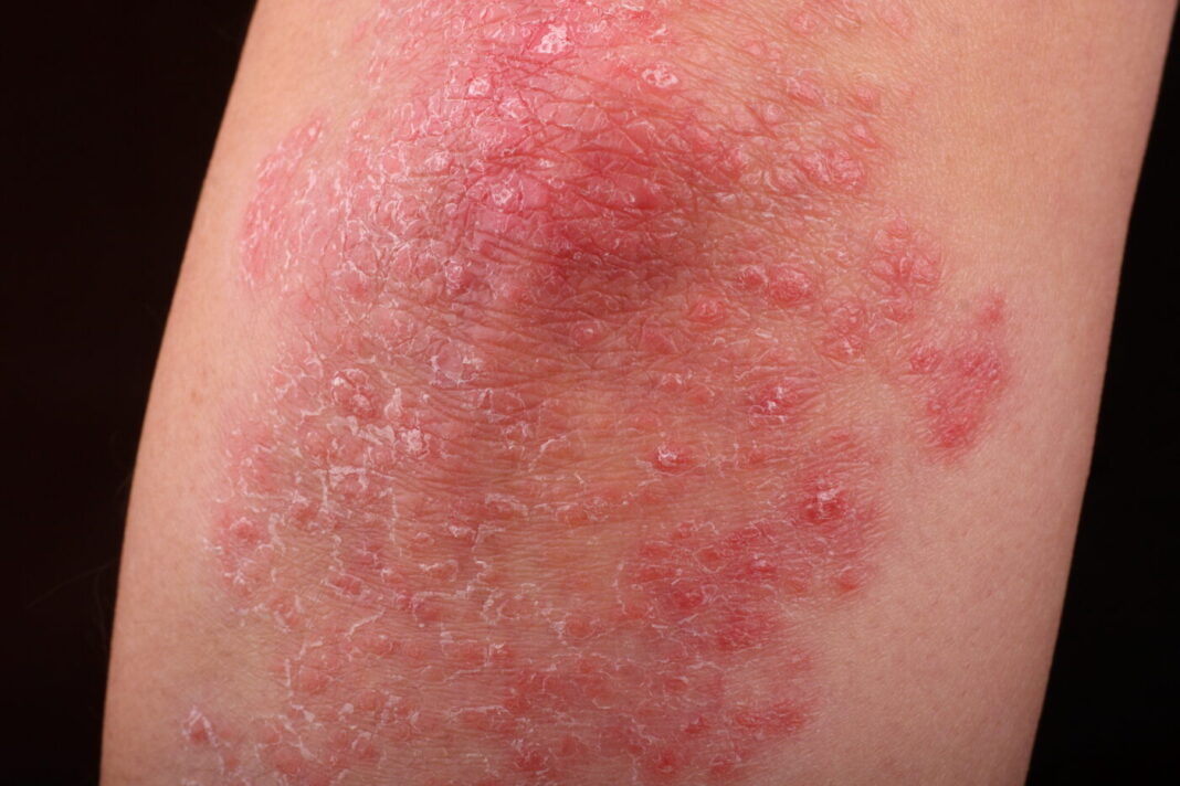 Psoriasis