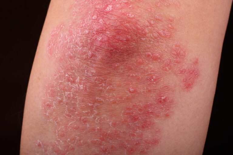 Psoriasis Severity Potentially Reduced by Targeting Protein