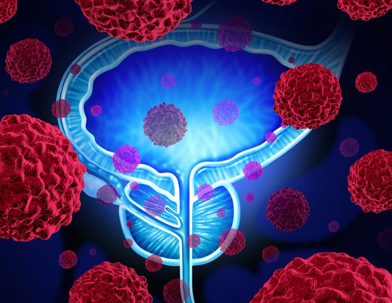 Protein Biomarker Differentiates between Cystitis and Bladder Cancer